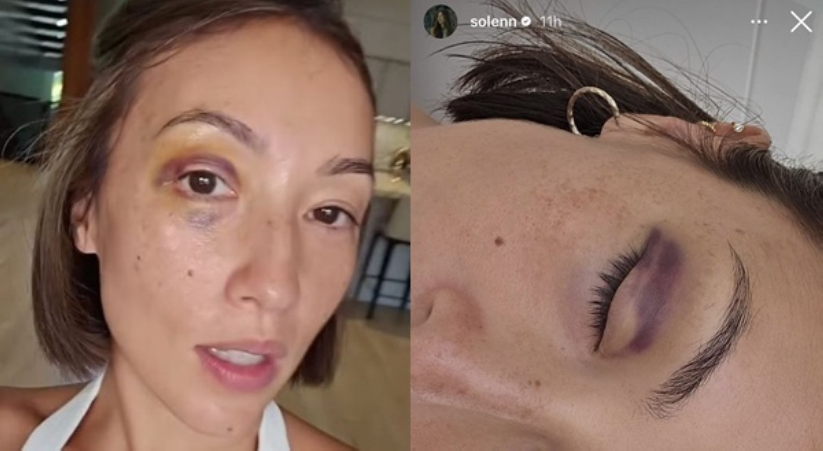 Solenn Heussaff, nagka-black eye dahil sa head butt ng anak