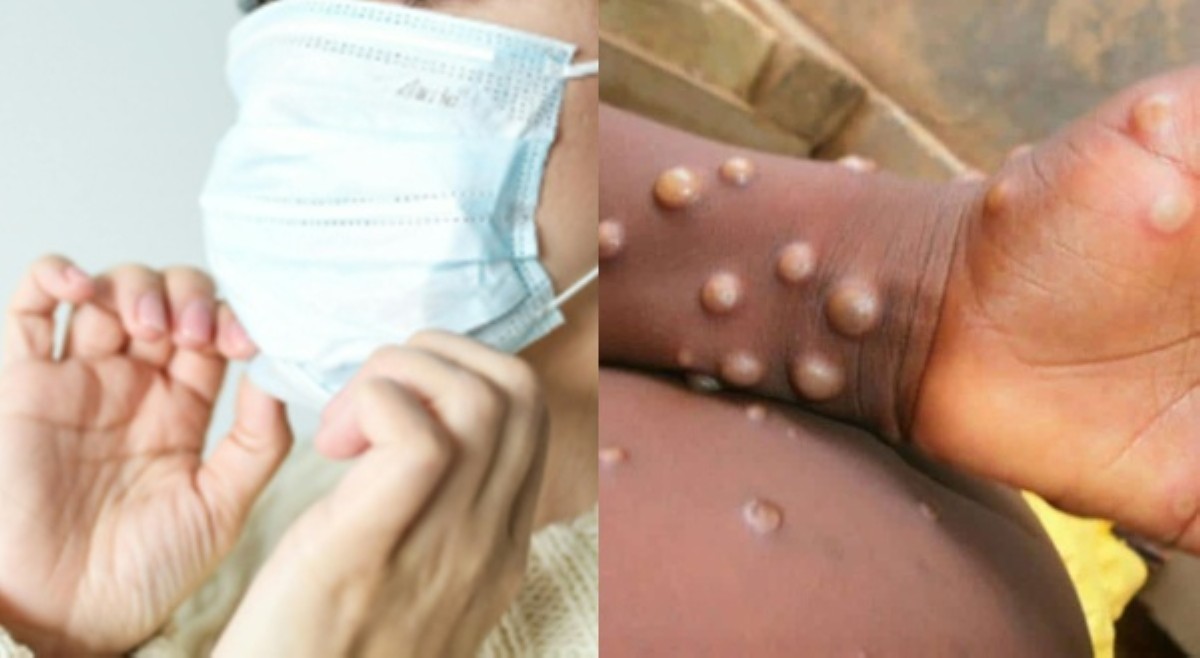 Mga taga-Davao Del Sur, Compostela required mag-face mask dahil sa mpox