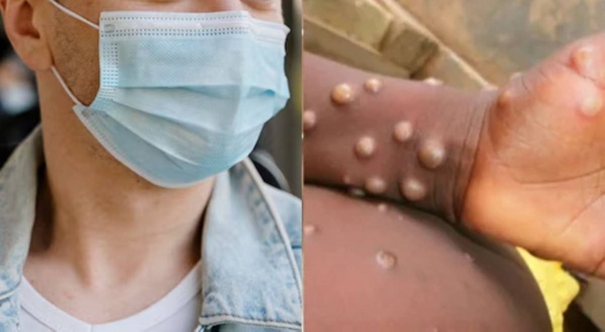 Face masks, hindi panangga vs mpox&mdash;DOH