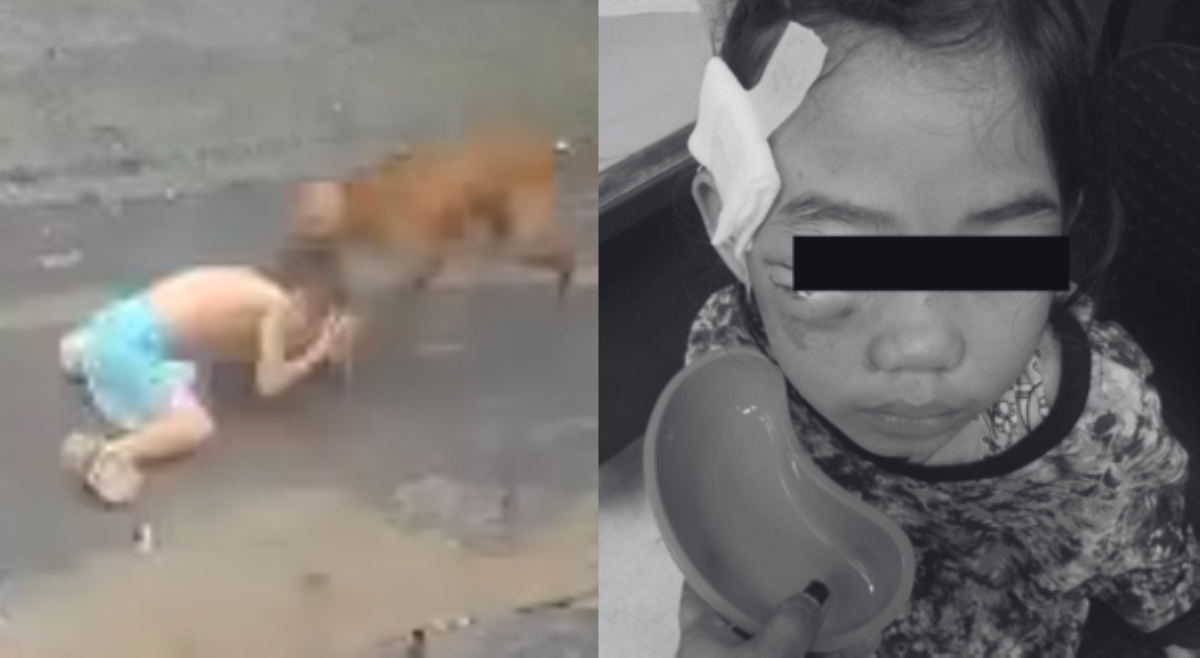 7-anyos na batang naligo sa ulan, sinakmal ng aso sa mukha