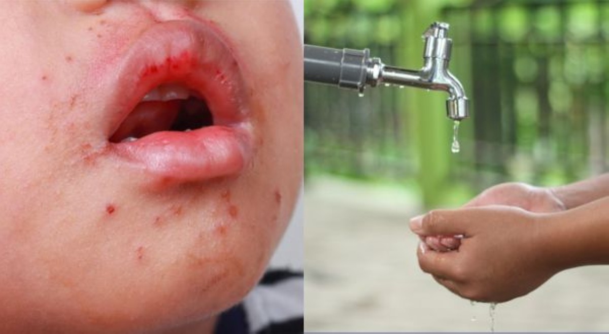 Nakaaalarma! Kaso ng hand, foot, and mouth disease, 7 beses ang itinaas sa unang kalahati ng taon