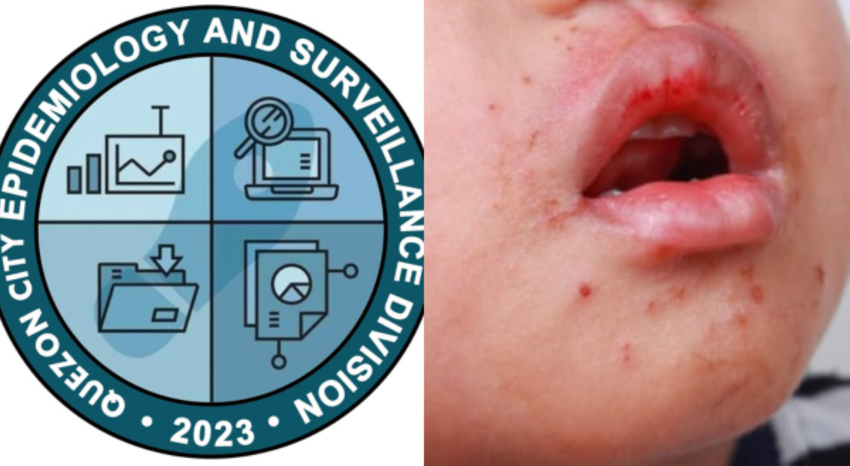 <b>Quezon City LGU, naaalarma sa 636% na pagtaas ng HFMD cases sa lungsod</b>
