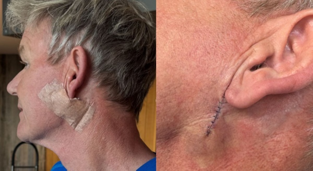 Gordon Ramsay, sumailalim sa skin cancer surgery