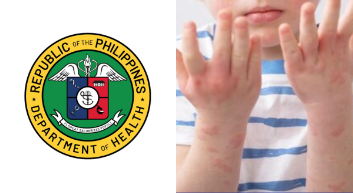 <b>Kaso ng HFMD, umakyat na sa 2,525 sa loob ng isang linggo, ayon sa DOH</b>