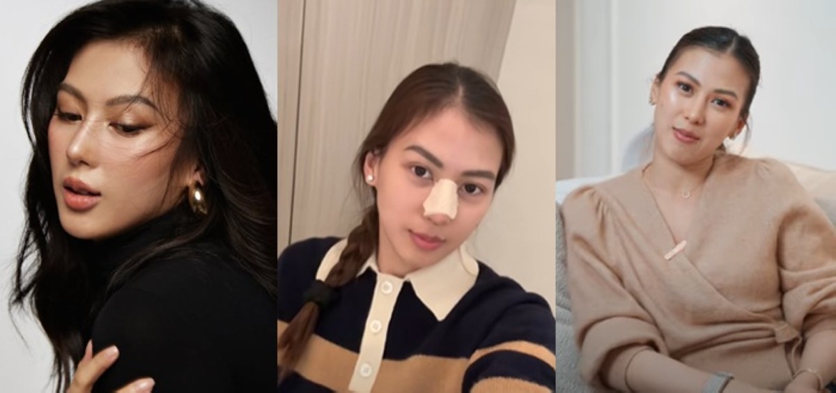 'Back to normal nose!' Alex Gonzaga, pinatanggal pinalagay sa ilong