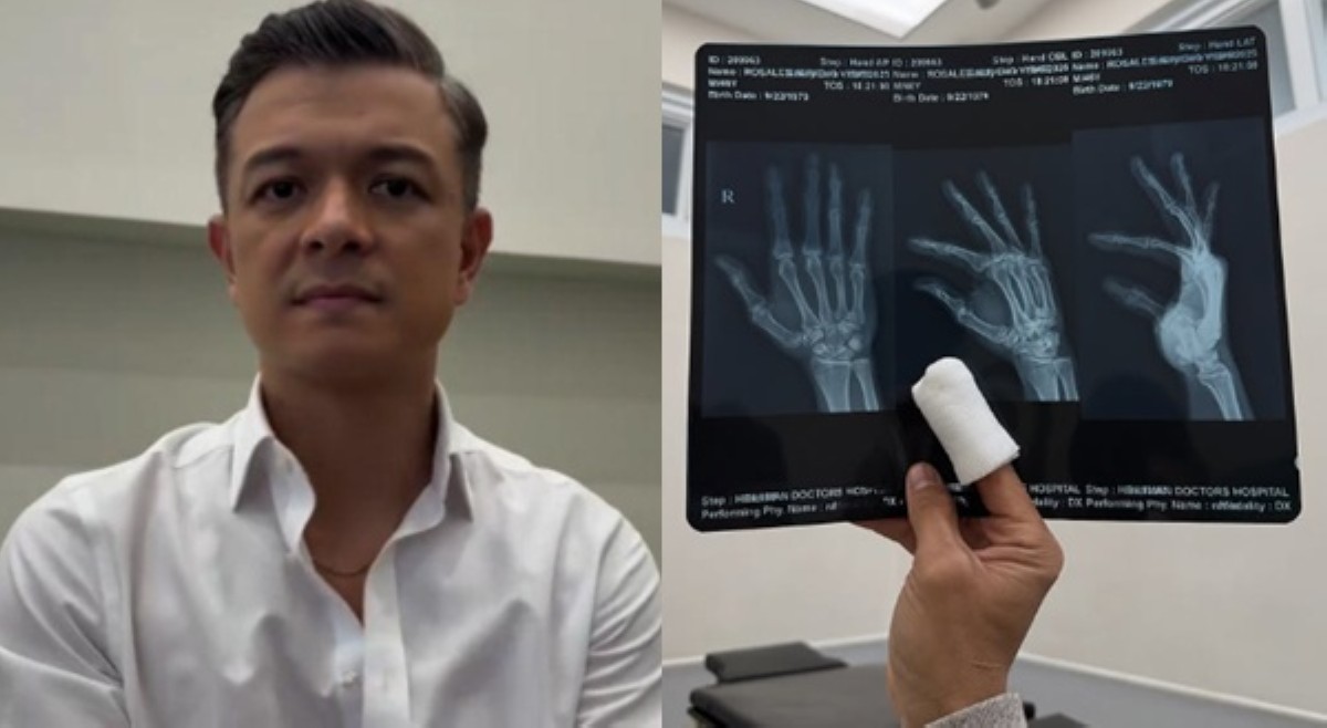 Anyare? Jericho Rosales, flinex injured na finger