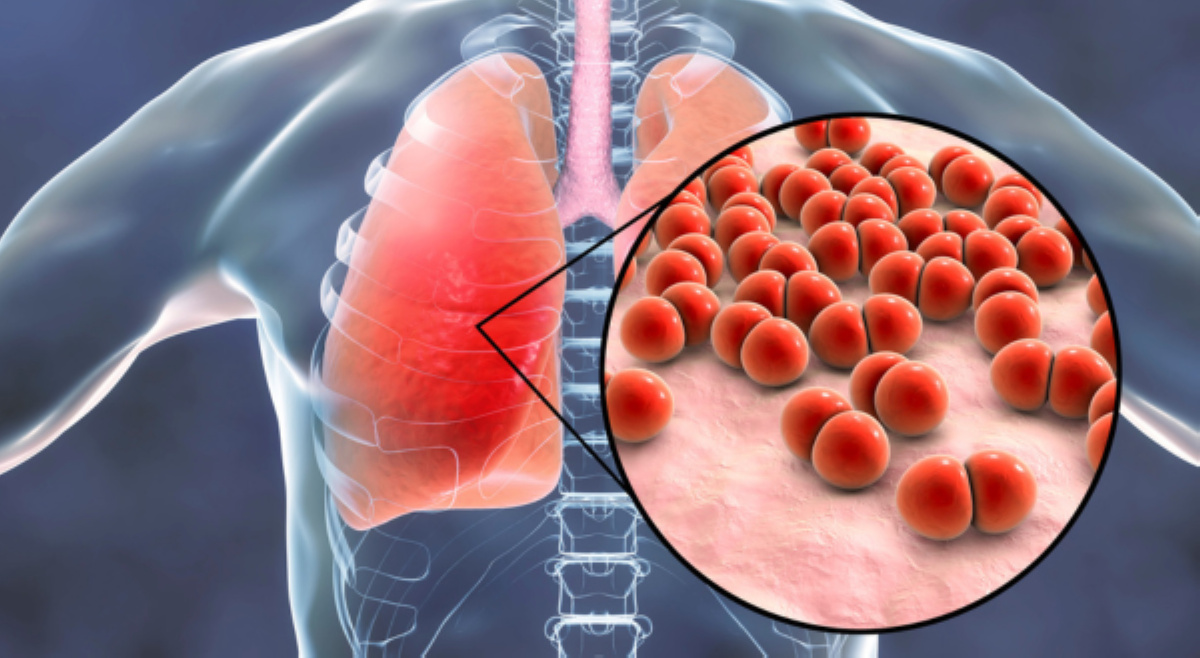 Pneumonia, pang-apat sa mga pangunahing sakit na ikinamamatay ng mga Pinoy&mdash;PHAP