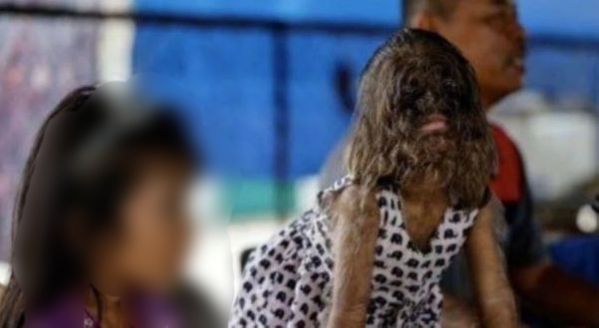 Paslit na may werewolf syndrome, nagsisimulang makibagay sa buhay-estudyante