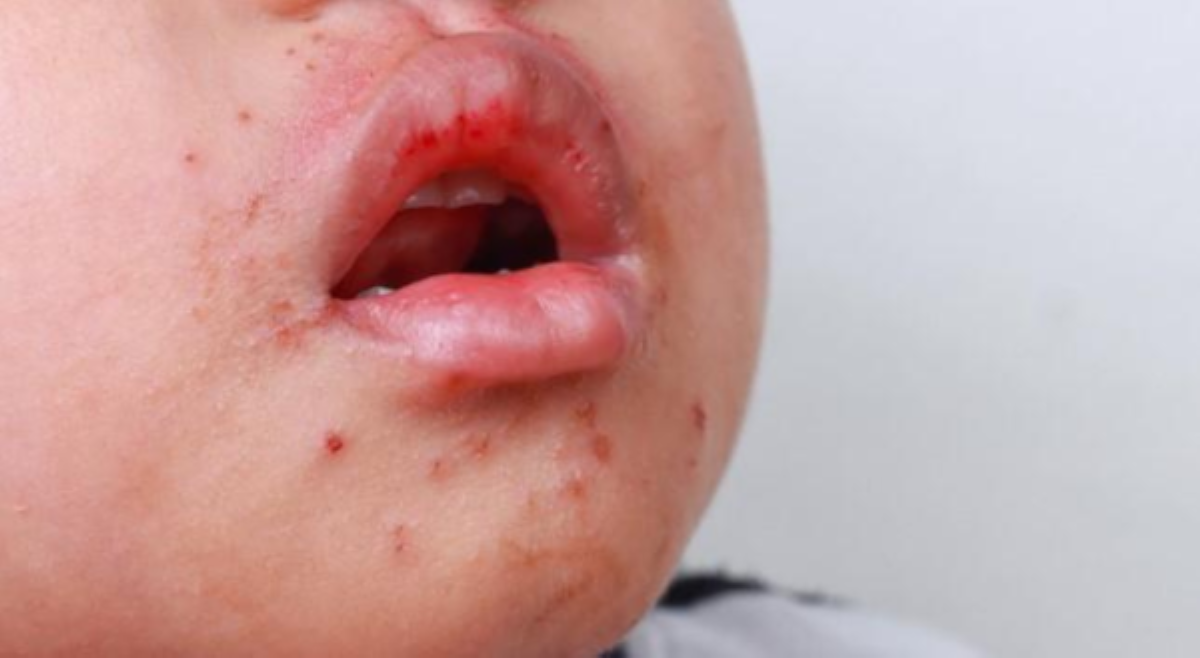 ALAMIN: Ano ang viral illness na Herpangina?