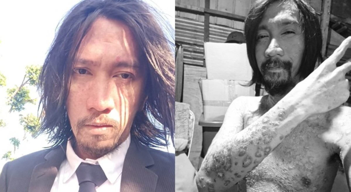 John Weak, tinamaan ng sakit sa balat