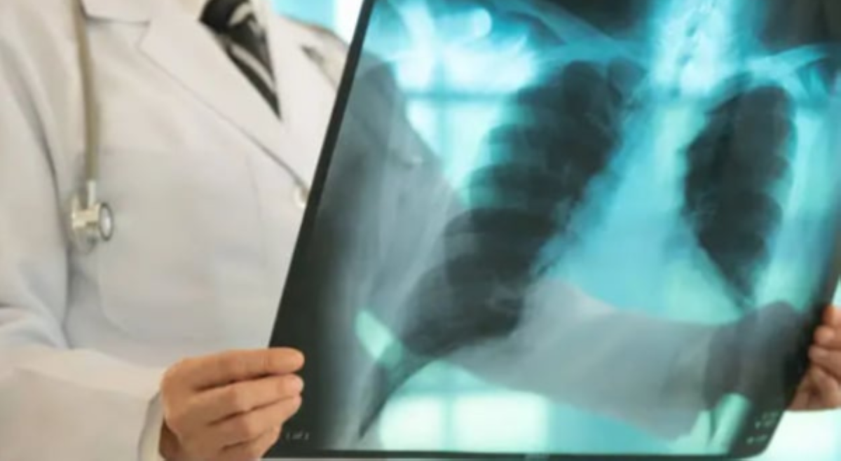 ALAMIN: Mga maling paniniwala tungkol sa Tuberculosis