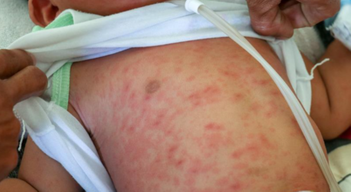 Kauna-unahang measles-related death sa QC ngayong 2026, isang 4 na buwang sanggol