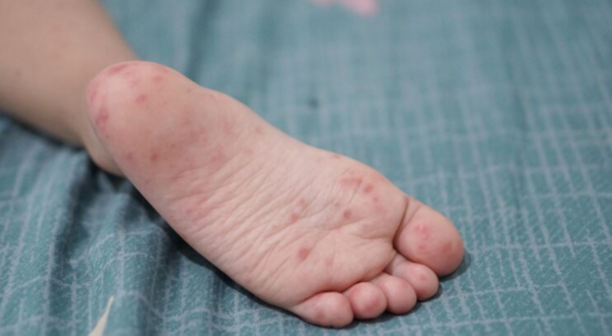 Kaso ng Hand, Foot, and Mouth Disease sa QC, pumalo na sa 81!