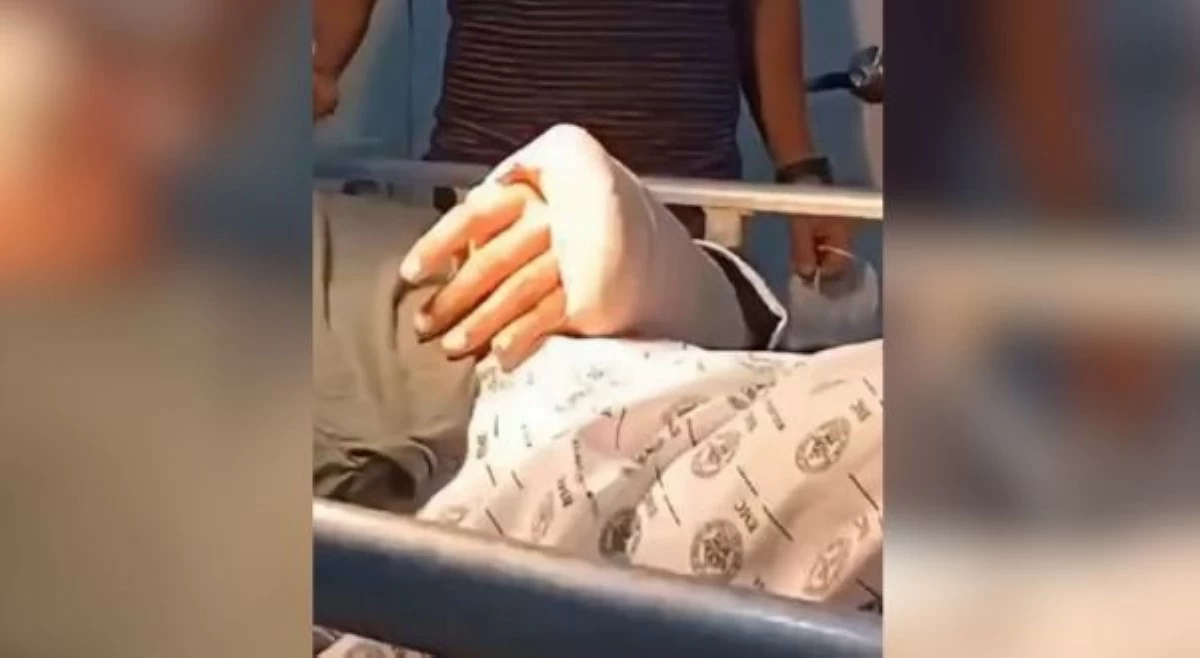 Kamay ng pulis na naputol sa pagresponde, naikabit na!