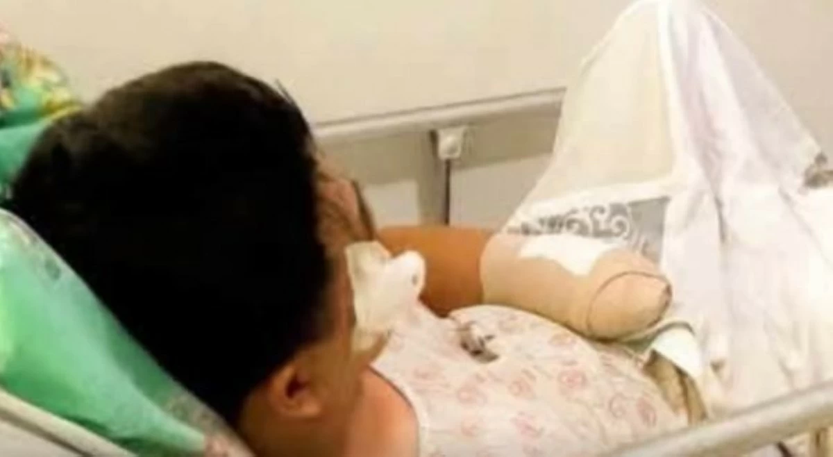 Kamay ng pulis na naputol at naikabit, tuluyan nang pinutol ng mga doktor!