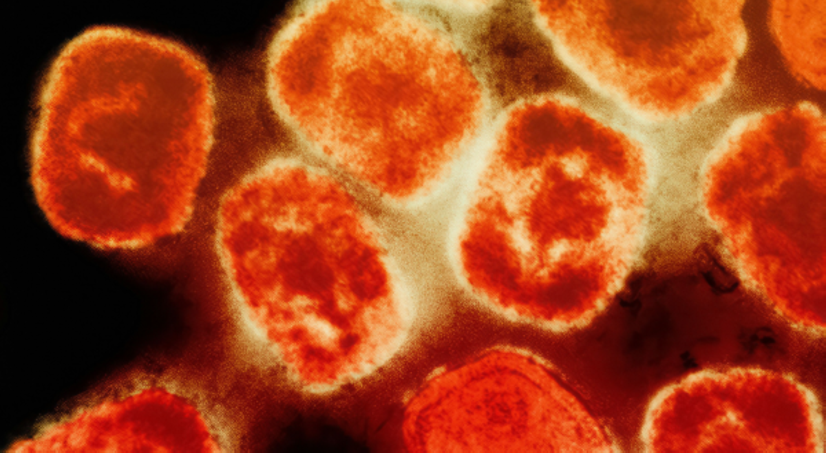 DOH, kinumpirma bagong kaso ng mpox sa 'Pinas