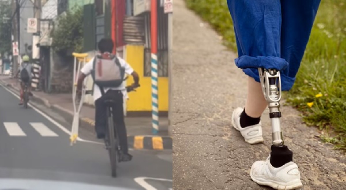 Estudyanteng naputulan ng paa dahil sa sakit, gustong magkaroon ng prosthetic leg