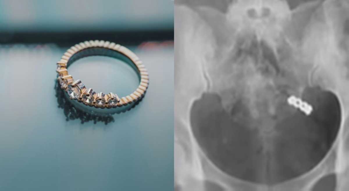 Misis aksidenteng nalunok wedding ring matapos uminom ng vitamins