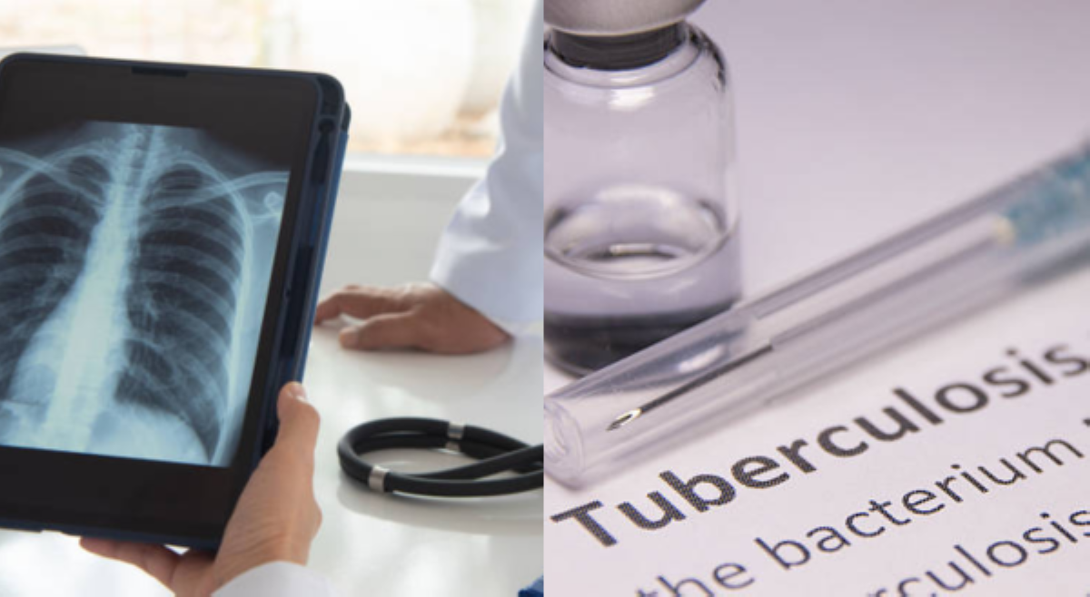 Tuberculosis, nangungunang infectious disease killer sa mundo&mdash;WHO